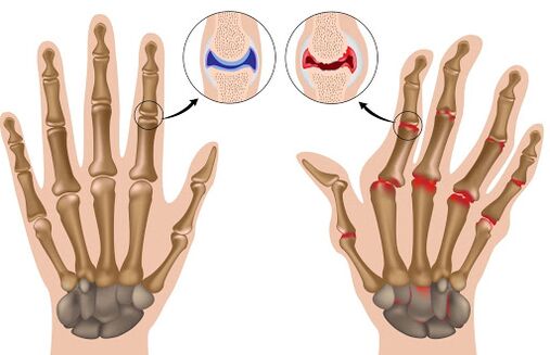 Arun Arthritis ati ifarahan rẹ