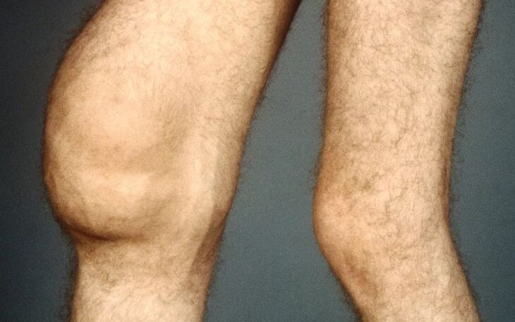 Post -tratumomic arthrosis ti orokun orokun