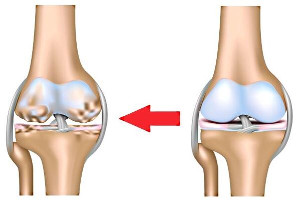 Apapọ apapọ ati arthrosis