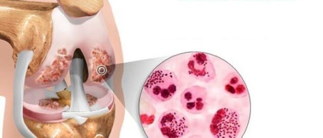 eyiti o yori si idagbasoke arthrosis