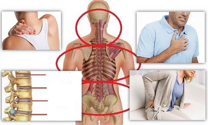 Awọn aye ti arun fun osteochondrosis