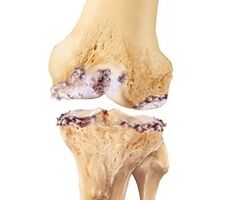 Bibajẹ si apapọ orokun nitori arthrosis