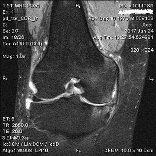 Osteoarthritis ti apapọ orokun lori MRI