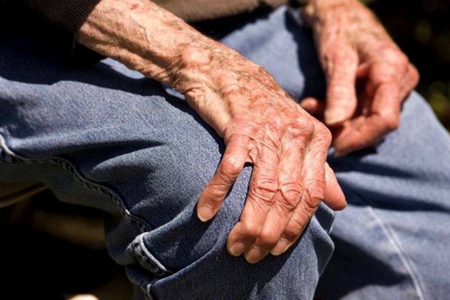 Arthrosis jẹ arun ti o ni ibatan ọjọ-ori ti o waye ninu awọn agbalagba