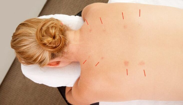 Acupuncture fun osteochondrosis thoracic, eyiti o ni ọpọlọpọ awọn anfani