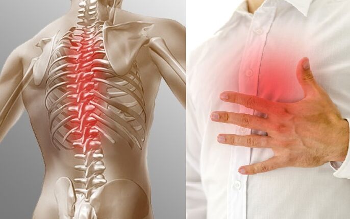 Thoracic osteochondrosis jẹ afihan nipasẹ irora ati rilara ti wiwọ ninu àyà